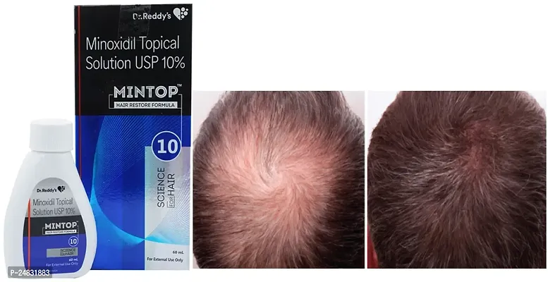 ..MINTOP HAIR SOLUTION USP 10%-thumb0