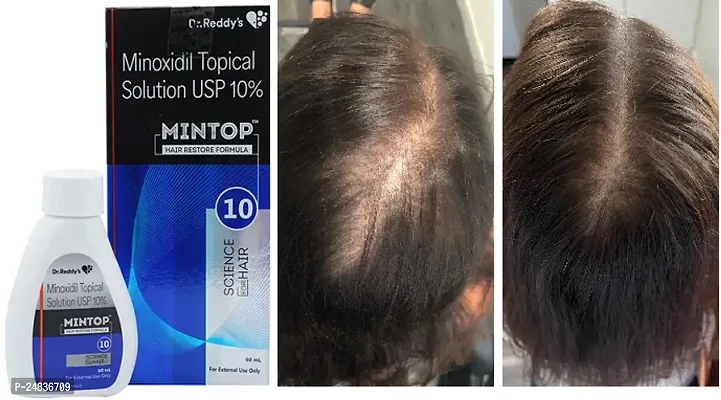 *MINTOP HAIR SOLUTION USP 10%