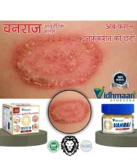 Castle Kart Vidhmaan Ayurveda Vanraj Anti fungal Malam = for Ringworm, itching, Eczema  Fungal Infection. (Pack Of 1)-thumb1