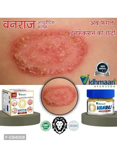 Castle Kart Vidhmaan Ayurveda Vanraj Anti fungal Malam = for Ringworm, itching, Eczema  Fungal Infection. (Pack Of 1)-thumb2