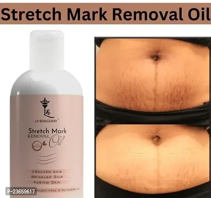 Stretch Mark For Pregenent Women, Pregnent Lady Stretch Mark Oil, Stretch Mark Removal Oil,Stretch Mark Remover Oil, Stretch Mark Cream Pet Ke Stretch Mitaye , Dagh Hata Ne Vala Tel ,Purane Aor Jidii Sterch Hatane Vala Tel-100Ml |Pack Of 1