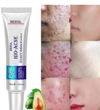 Bioaqua Pimple and Acne Cream for Pimple and Pimple Marks