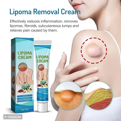 Lipoma Remover Cream Lump Remover Fat lump Remover-thumb3