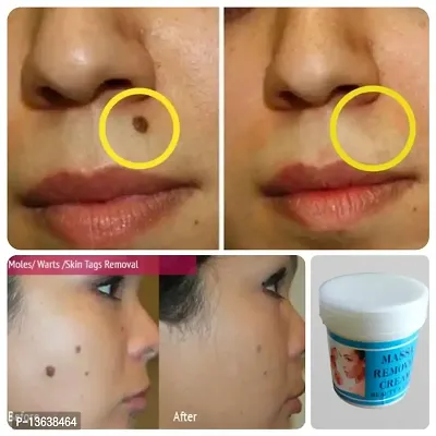Massa Nashak Cream,Painless Mole,Wart Removal Cream For Men  Women