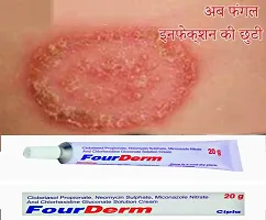 Four Derm  Anti fungal Cream  - for Ringworm, itching, Eczema  Fungal Infection 20 Gm ( PACK OF 2)-thumb2