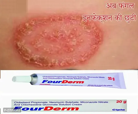 Four Derm  Anti fungal Cream  - for Ringworm, itching, Eczema  Fungal Infection 20 Gm ( PACK OF 2)-thumb3