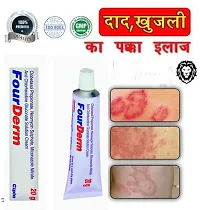 Four Derm  Anti fungal Cream  - for Ringworm, itching, Eczema  Fungal Infection 20 Gm ( PACK OF 2)-thumb1