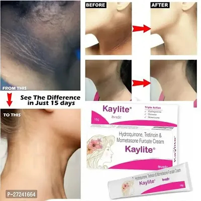 Kaylite Face Cream for Melasma, Dark spots, Pigmentation (Pack of 1) 15 Gm