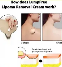 Lipoma Removal Cream Ointment, Lipoma Elimination Cream,Lipoma Treatment Cellulite Removal Cream, Anti-Swelling Lymphatic Ointment 20g (Pack of 1)-thumb2