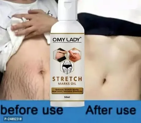 OMY LADY  Stretch Marks Removal Oil (50ml)