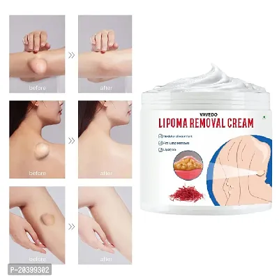 Herbal Lipoma Gaanth Removal Cream lipoma ganth  (50 g)-thumb0