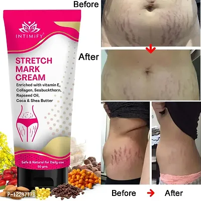 Stretch Mark Cream for Women for Scars, Stretch Mark, Ageing, Uneven Skin Tone, Firming  Nourishment Stretch mark remove krne ke liye cream, scars remove krne ke liye cream, cream for women, cream fo