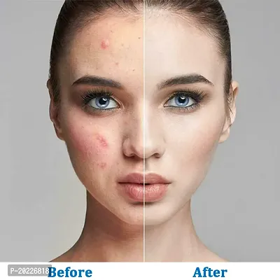 KURAIY Salicylic Acid 2% Masque Formulated Deep Cleansing Face mask 100ML-thumb5