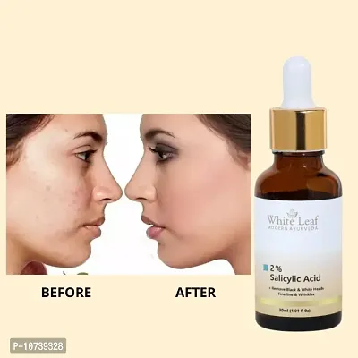 White Leaf 2% Salicylic Acid Serum For Acne, Blackheads  Open Pores Serum For Oily Skin  (30 Ml)