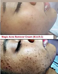 Collagen Magic Acne Remover Cream Soap 80gm- Set of 1-thumb2