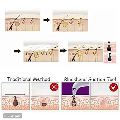 Beautiful Skin Care Expert Acne Pore Cleaner Vacuum Blackhead Remover Kit Skin Cleaner(pack of 1)-thumb4