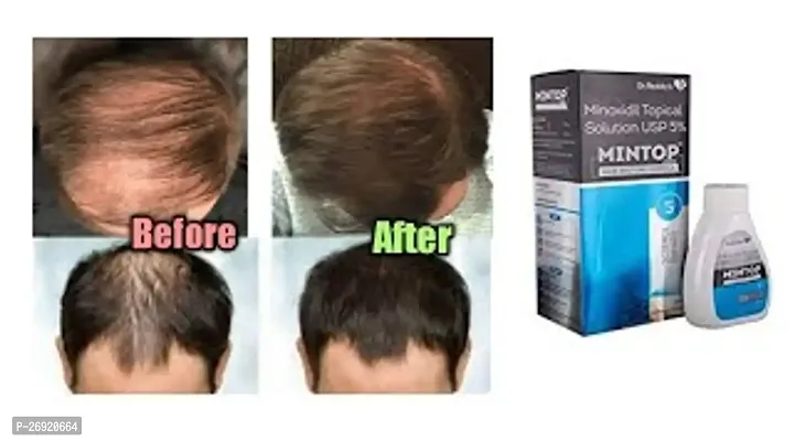 New mintop minoxidil 10% solution pack of 1-thumb0