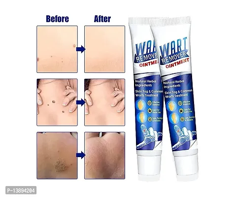 Warts Remover Cream Extract Skin Face Tag Extract Corn Treatment Ointment Painless For Men Women Children