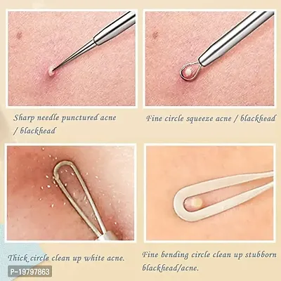 Lele Blackhead Acne Removal Needle Kit 5Pcs with storage box Cleaning Tool Blemish Pimple Comedone for Women and Men-thumb2