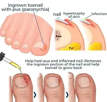 Nail Treatment Liquid for Fingernails Toenails Strengthening Unhealthy Nails, Nail Fungus Treatment Fix And Renew Nails 30ml (Pack Of 1)-thumb1