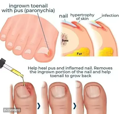 Nail Treatment Liquid for Fingernails Toenails Strengthening Unhealthy Nails, Nail Fungus Treatment Fix And Renew Nails 30ml (Pack Of 1)-thumb2