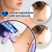 Wart Removal Cream Helps to remove toughest Wart 100gm-thumb2