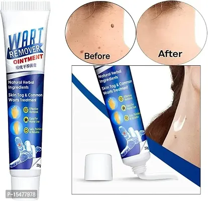 Warts Remover Ointment Wart Treatment Cream Skin Tag Remover Herbal Extract