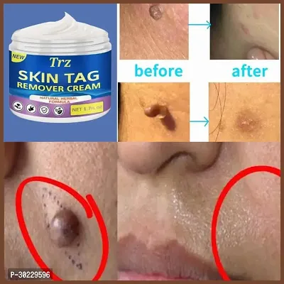 Best Skin Tag Remover Cream