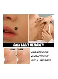 Best Skin Tag Remover Cream-thumb1