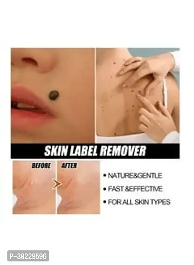 Best Skin Tag Remover Cream-thumb2