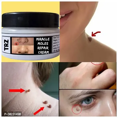 Best Magical Wart,Moles And Massa Remover Cream