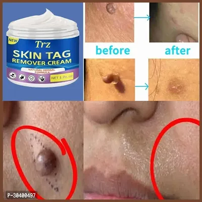 Mole Cream Cure for Warts-thumb0