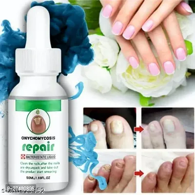 Nail Serum for Nail Growth  Repair, Fungal Infection, Anti-infective Removal Paronychia Onychomycosis 30ml-thumb0
