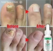 Growth Oil/Nail Growth Serum Nail Treatment Repair Gel Feet Care Bright Nail Armor Repair Anti Infection Onychomycosis Fungal Nail Treatment Cream/ nail grow oil/ best nail growth serum in india/ best-thumb2