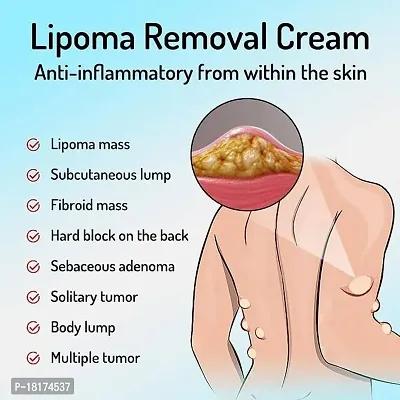Fozzby 20g Lipoma Removal Cream Mild Easy to Use Care Cream Wide Applaications | Mild  Comfortable | Herbal Remedies  Resins-thumb3