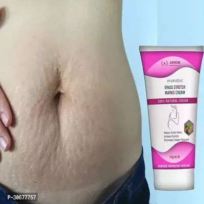 Stretch Mark Is Suitable for Pregnancy Stretch Marks, (100 G)