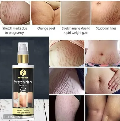 Forecast Present Repair Stretch Marks Removal - Natural Heal Pregnancy Breast, Hip, Legs, Mark Oil 100 Ml Pack Of 1-thumb0