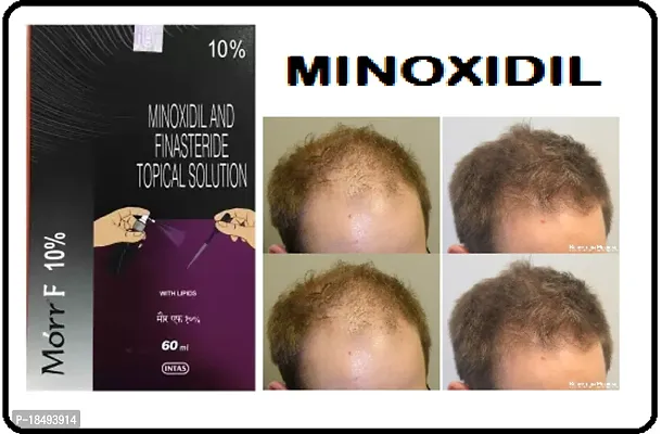 minoxidil and finestride topical solution 10%-thumb0