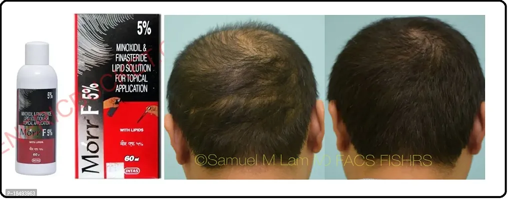 minoxidil morr F 5%