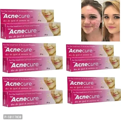 5 Acnecure for the treatment of acne and pimples 20gm(Pack of 5)