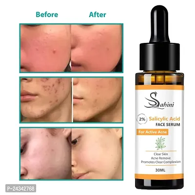 sahini 2% salicylic face serum for active acne clear skin acne remove promotes clear complexion 30ml c pack-1