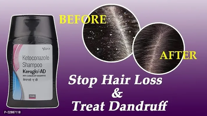 Keraglo - AD Anti-Dandruff Shampoo is an antifungal medicine used to treat fungal infections of the skin. (1pcs)-thumb5