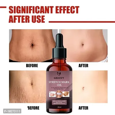 Stretch Marks Oil Organics Stretch Mark Removal Oil Men Under Arms Stretch Mark Bio Oil And Scars Removal 40 Ml-thumb0