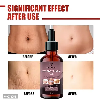 Stretch Marks Oil  organics stretch mark removal oil Men under arms stretch mark bio oil and Scars Removal  40 ml)-thumb0