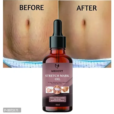 Stretch Marks Oil present Repair Stretch Marks Removal Cream - Natural Heal Pregnancy Breast  Hip  Legs  Mark OIL 40ml  pack of 1) 40ml-thumb0