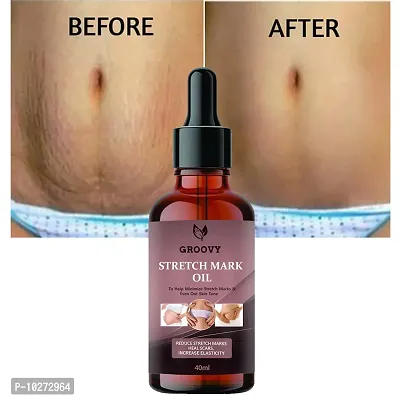 Stretch Marks Oil Present Repair Stretch Marks Removal Cream - Natural Heal Pregnancy Breast, Hip, Legs, Mark Oil 40Ml 40Ml-thumb0