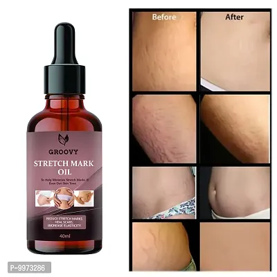 Stretch Marks Oil  Sparsh Natural Stretch Oil  14 Herbal Oils-Kachur  Jiwanti  Peepal and Nariyala  40ml ml)-thumb0