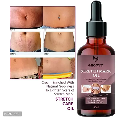 Stretch Mark Oil with the Goodness of Seabuckthorn Oil  Vitamin E and C  Lavender | All Skin Types | For Scars  Stretch Marks-40ml-thumb0