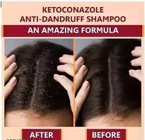 Alkem Ketokem Anti-Dandruff Shampoo For Men  Women 2x110mlpackof5-thumb3