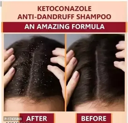 Alkem Ketokem Anti-Dandruff Shampoo For Men  Women 2x110mlpackof5-thumb4